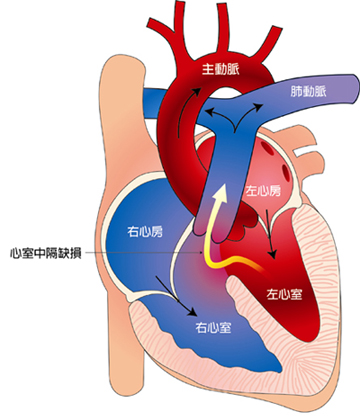 欠損 症 中 隔 心室